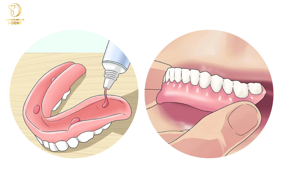 Người sử dụng hàm giả tháo lắp thường xuyên phải sử dụng keo dán hàm giả để cố định hàm