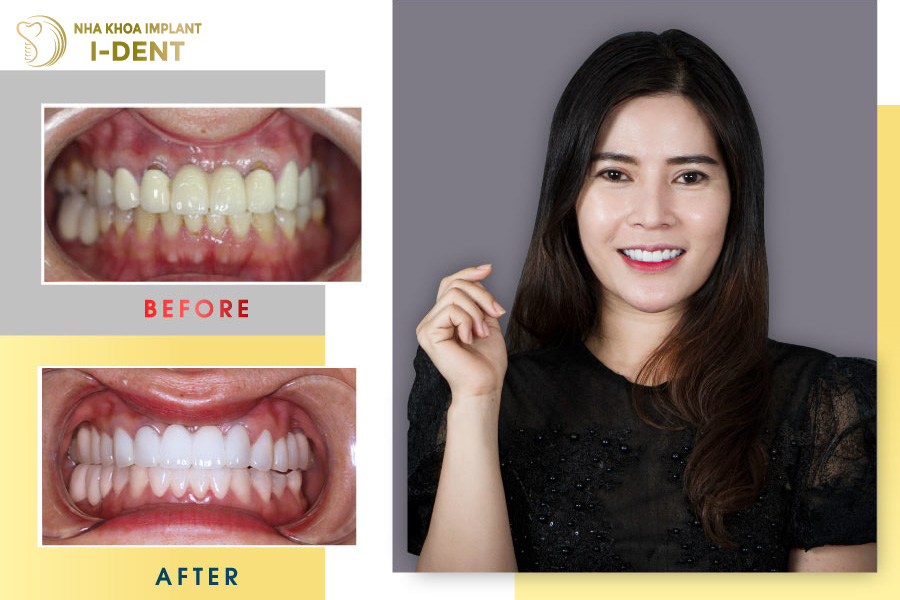 Khách hàng sau khi bọc sứ tại nha khoa I-DENT