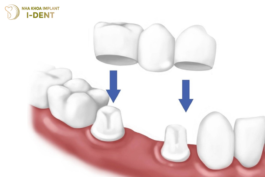 Kỹ thuật cầu răng sứ giúp khôi phục răng mất