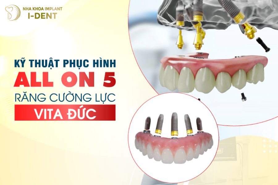 Sử dụng răng cường lực Vita Đức trong kỹ thuật phục hình All on 5