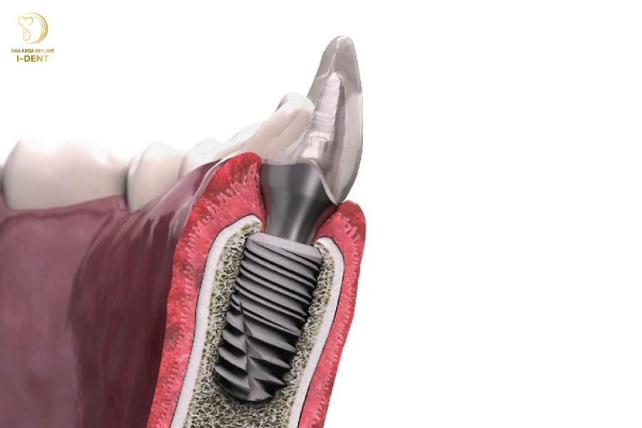 Làm răng khểnh bằng cấy ghép Implant 