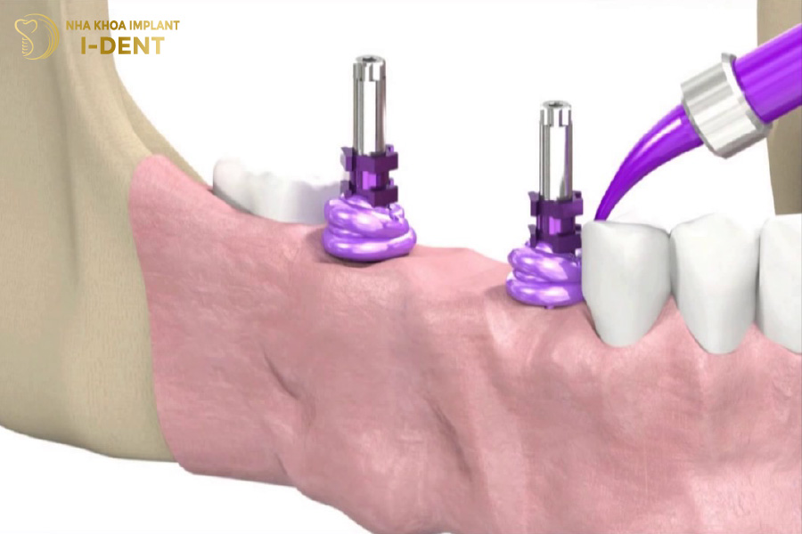 Lấy dấu Implant giúp chế tác mão sứ phù hợp với trụ răng 