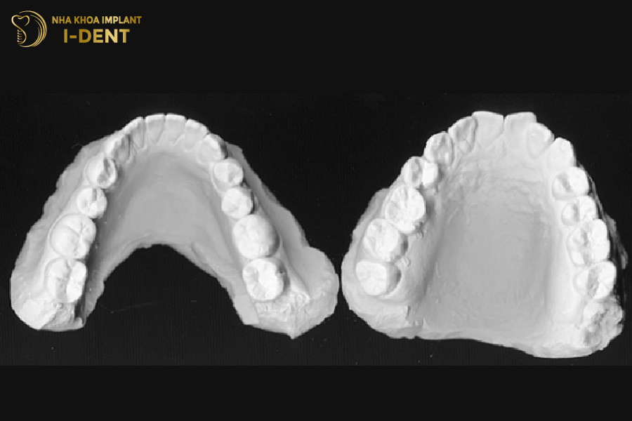 Lấy dấu răng bằng thạch cao