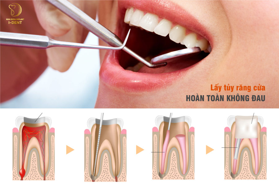 Lấy tủy răng cửa hoàn toàn không đau