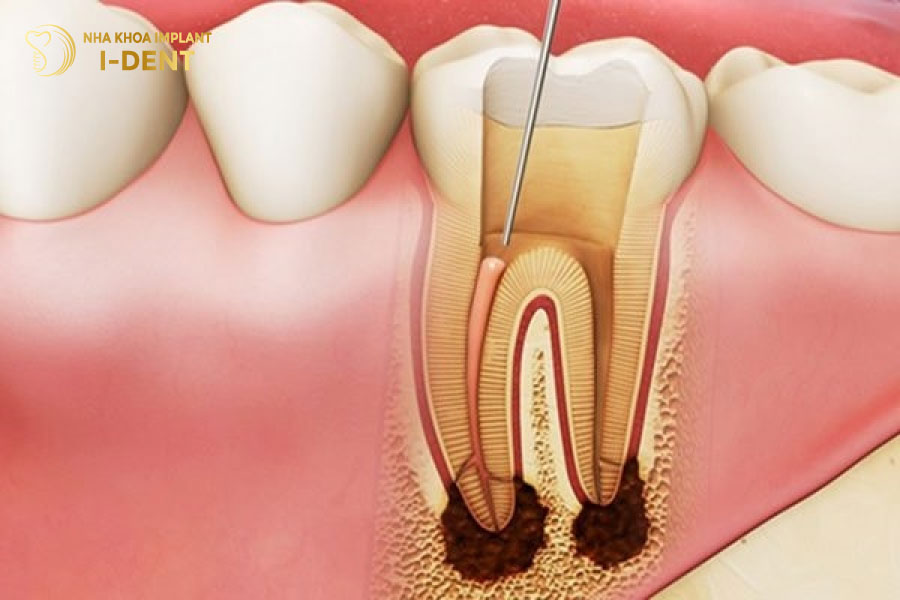 Lấy tủy răng ngăn chặn tình trạng viêm nhiễm và tổn thương các bộ phận khác.