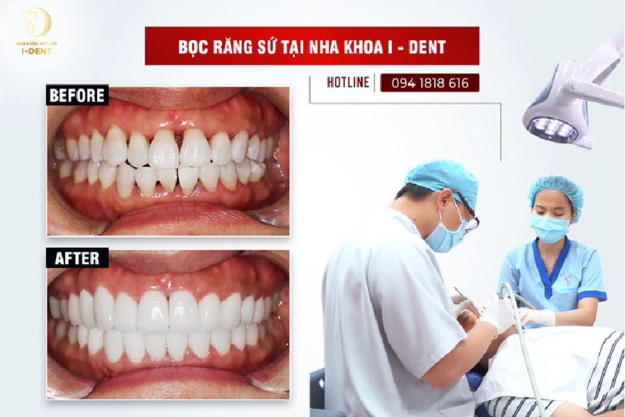 Để tăng tính thẩm mỹ cho cả hàm răng, nhiều khách hàng chọn bọc 16 răng sứ