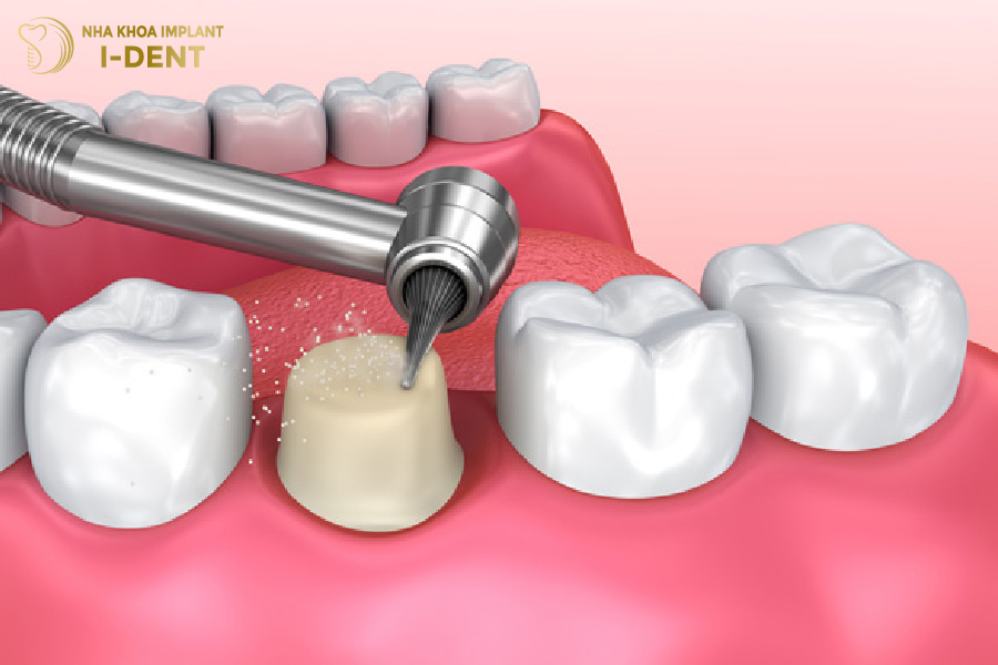 Mài cùi răng sứ có ảnh hưởng gì không?