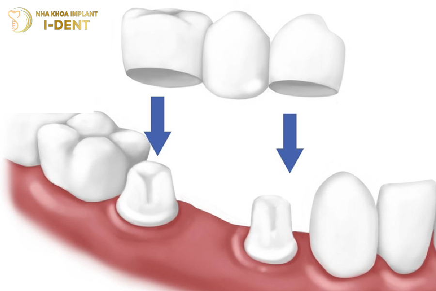 Cầu răng sứ cho 1 vị trí răng mất