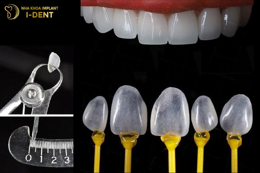 Mặt dán sứ Veneer Lingual/Palatal