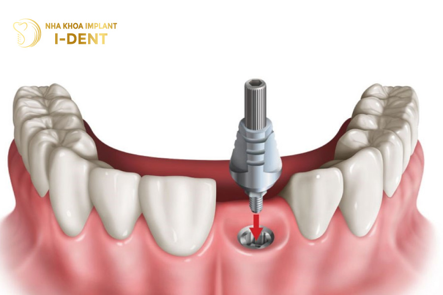 Trồng răng Implant vĩnh viễn