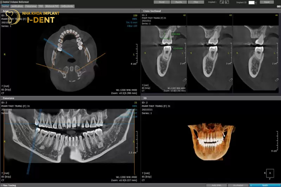 Máy CT Cone Beam thể hiện rõ độ rộng của xương hàm