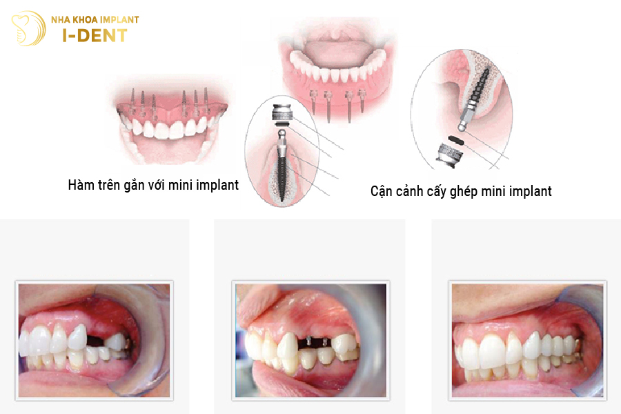 Mini Implant có thời gian lành thương nhanh