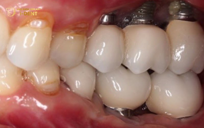 Mô mềm, xương hàm bị tổn thương là biến chứng nguy hiểm khi cấy Implant