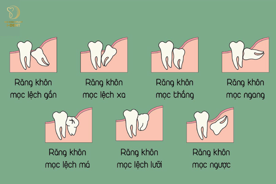 Một số tình trạng mọc răng khôn