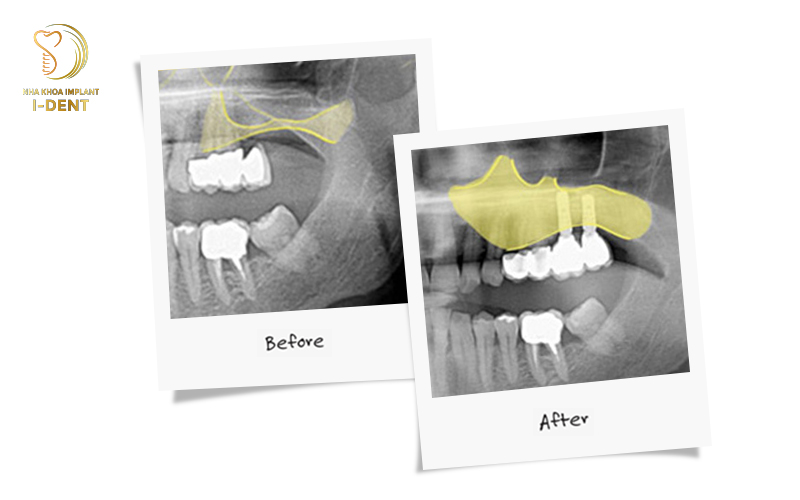 Nâng xoang hàm trong cấy ghép Implant