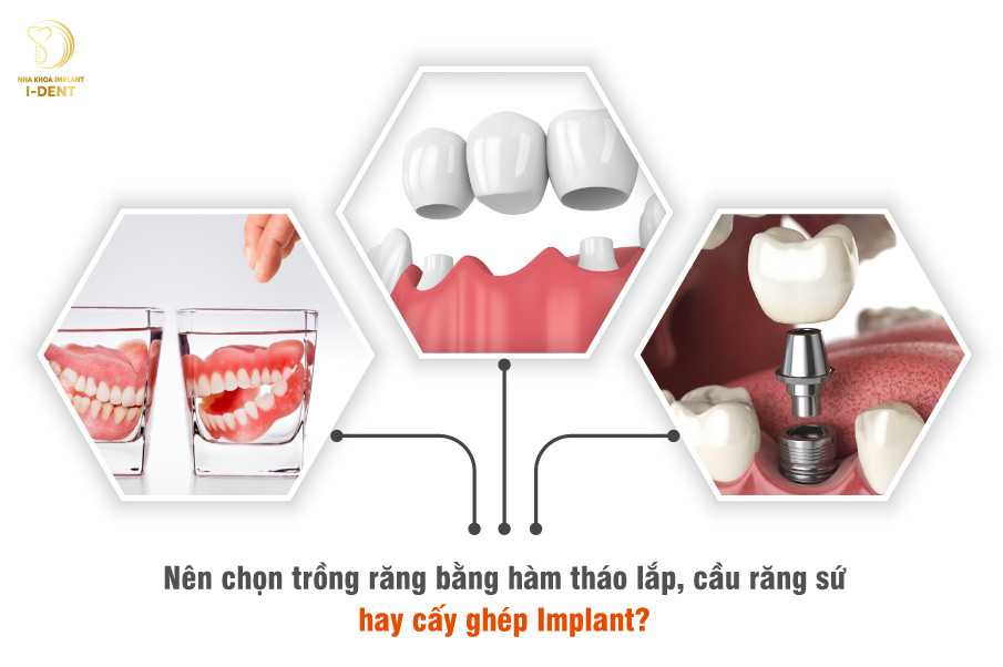 Nên chọn trồng răng bằng hàm tháo lắp, cầu răng sứ hay cấy ghép Implant?