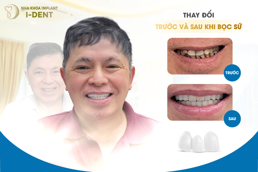 khách hàng sau khi bọc răng sứ tại Nha khoa I-DENT