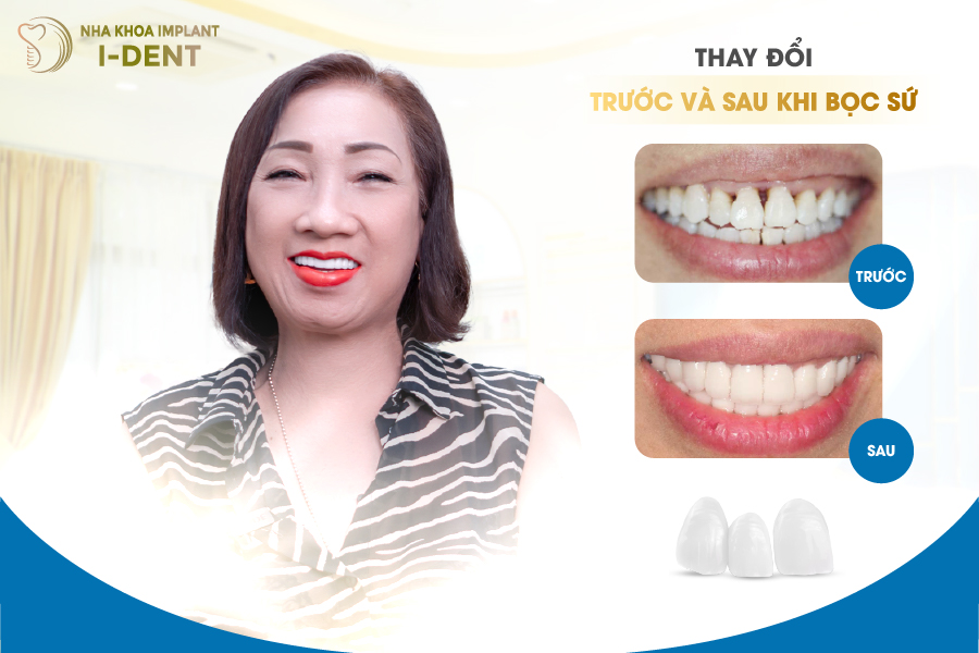 khách hàng sau khi bọc răng sứ tại Nha khoa I-DENT