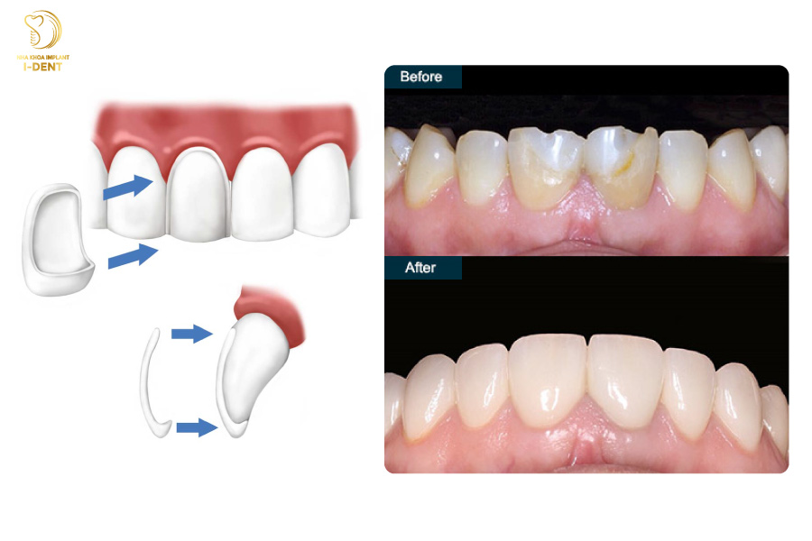 Tráng răng sứ áp dụng cho những trường hợp răng thưa, hở kẽ, ố vàng,...