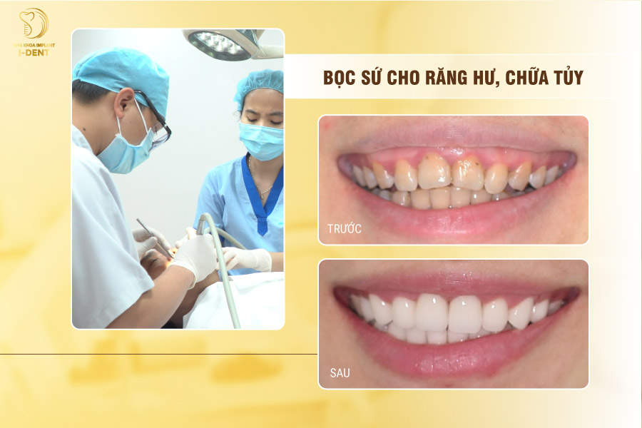 Bọc sứ cho răng hư, chữa tủy