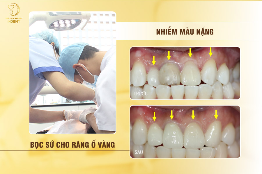 Bọc sứ cho răng ố vàng, nhiễm màu nặng