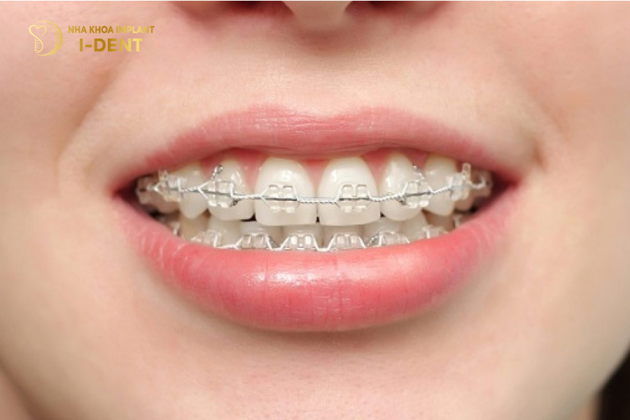 Niềng răng trước khi trồng Implant sẽ mang lại thẩm mỹ tối đa