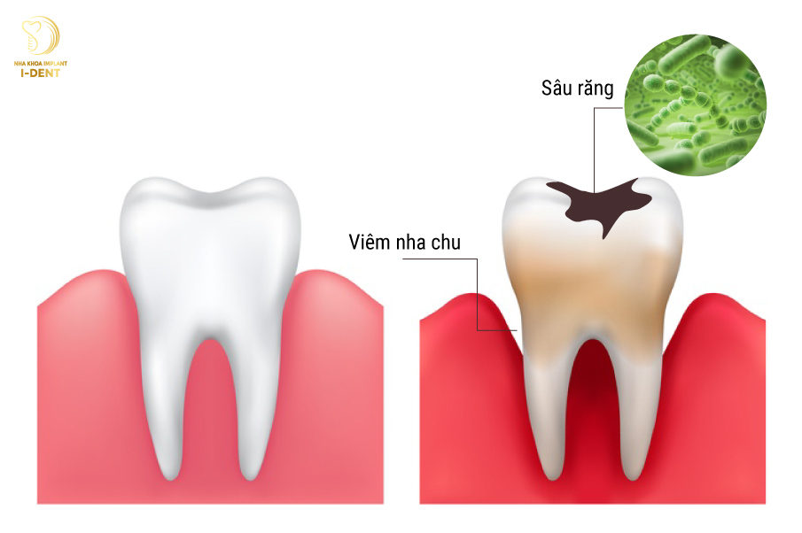 Phụ thuộc vào bệnh lý của răng