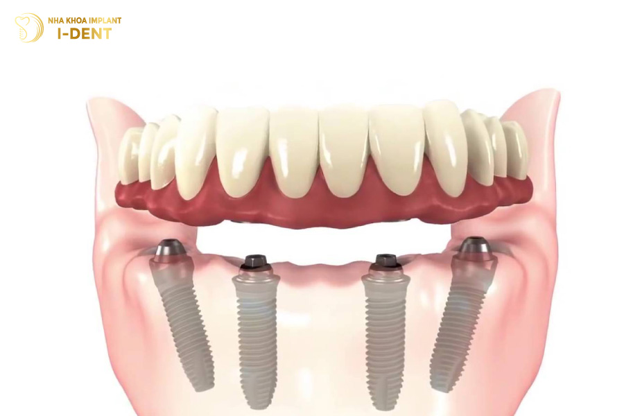 Phục hình toàn hàm Implant tháo lắp