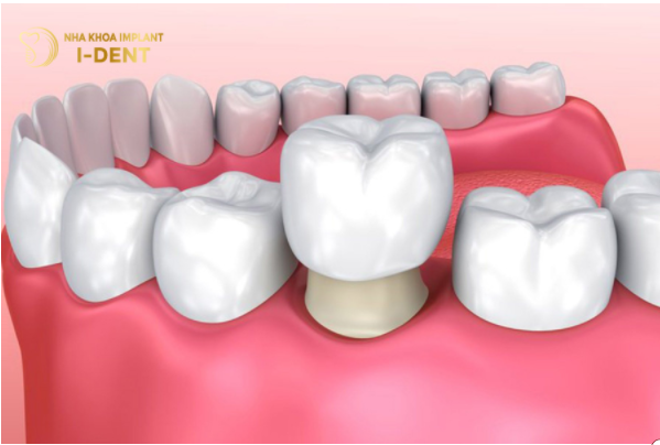 Phương án bọc răng sứ giúp cải thiện thẩm mỹ răng hiệu quả