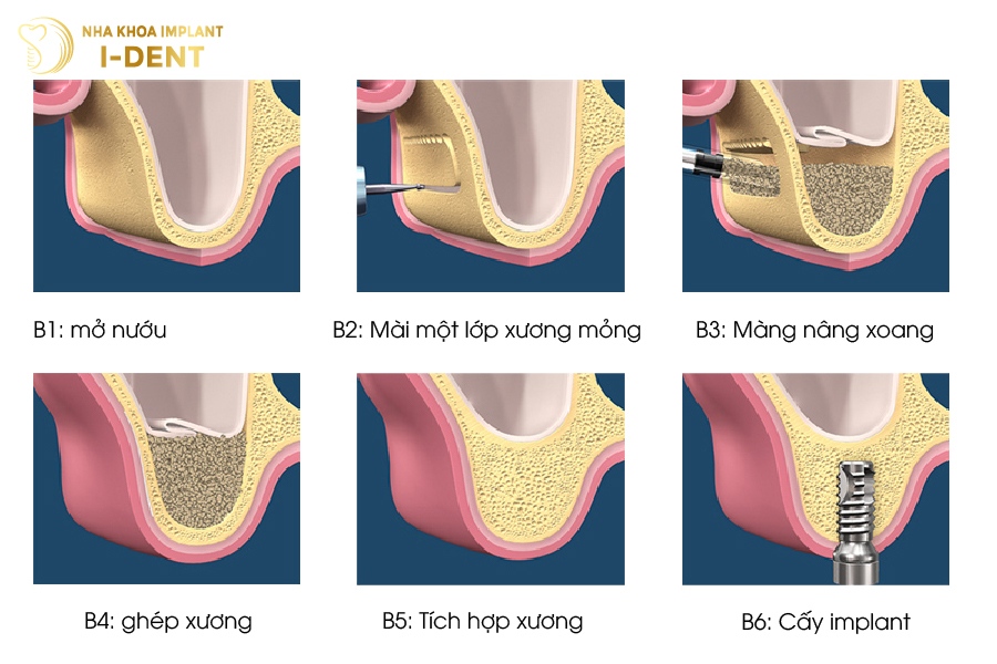 Quy trình nâng xoang hở