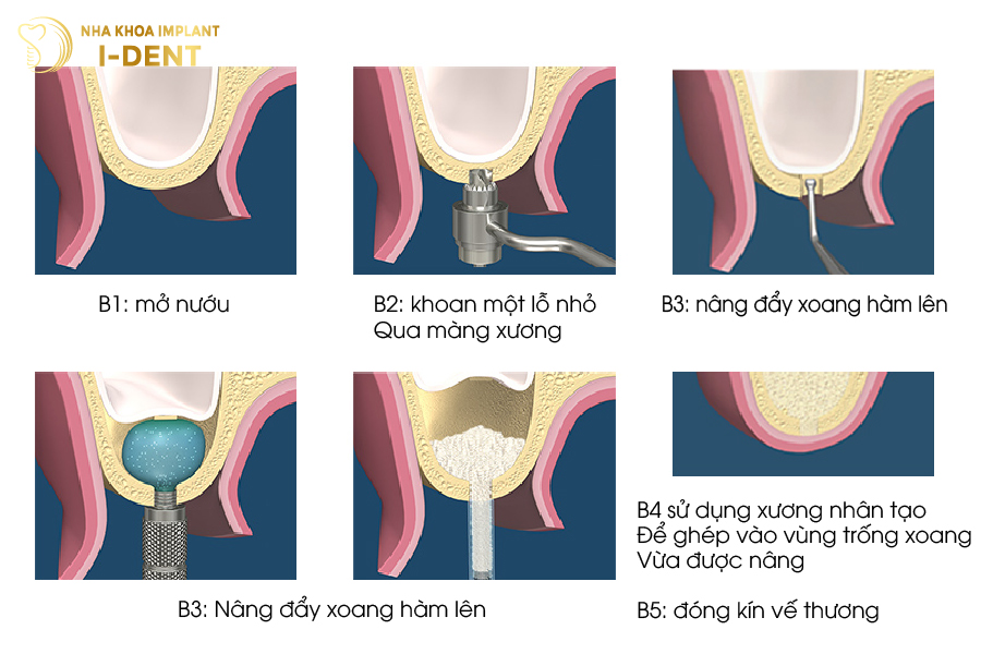 Quy trình nâng xoang kín