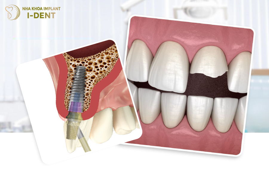 Răng bị bể lớn phải tiến hành nhổ và trồng răng implant