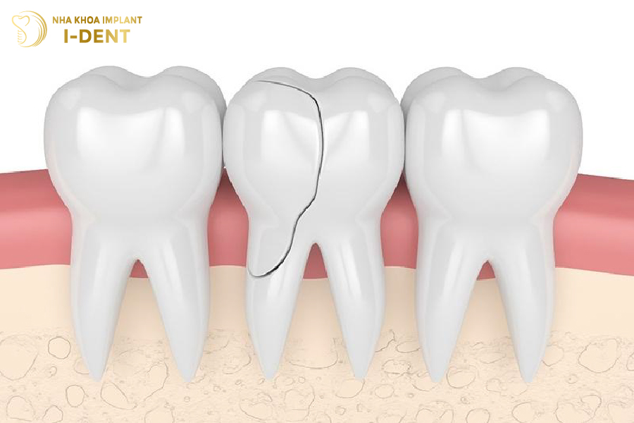 Răng bị gãy đôi theo chiều dọc