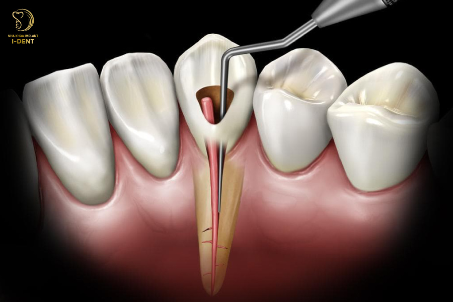 Viêm tủy răng gây hư răng thật