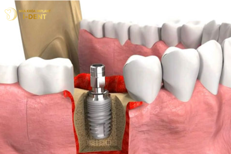 răng implant bị lung lay