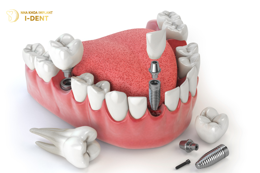 Trồng răng Implant cho răng cửa bị mất