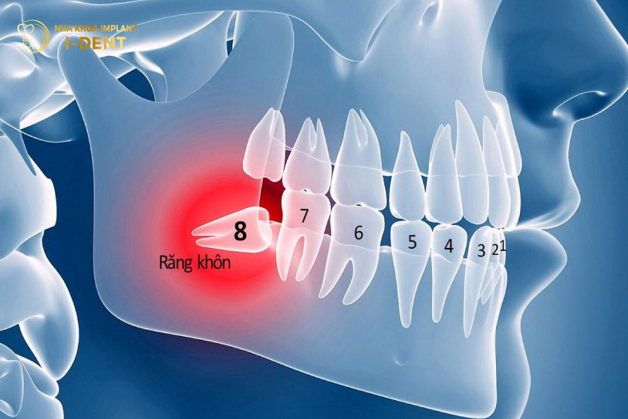 Răng khôn là răng mọc cuối cùng trên cung hàm