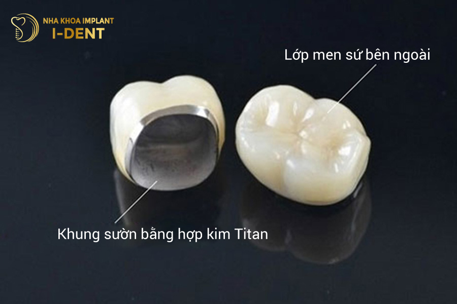 Răng sứ kim loại có khả năng chịu lực nhai tốt