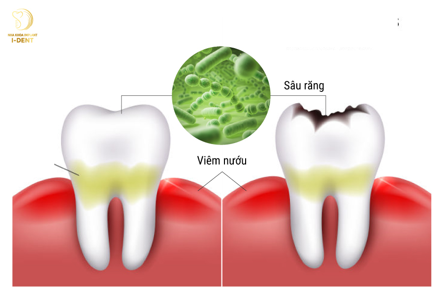 Sâu răng gây viêm nướu