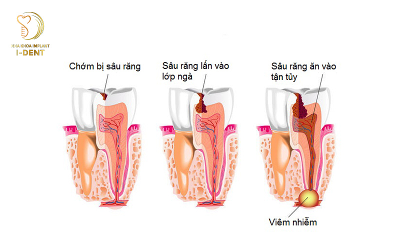 Răng bị viêm tủy