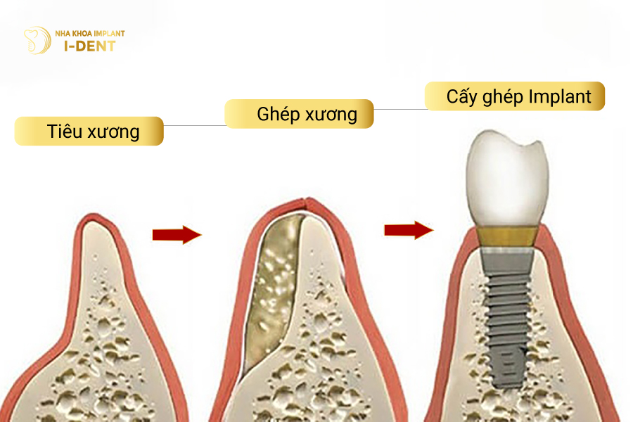 Ghép xương hỗ trợ cho trụ Implant được vững chắc trong xương hàm