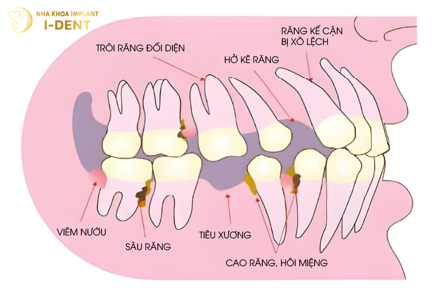 Vì sao nên trồng răng implant?