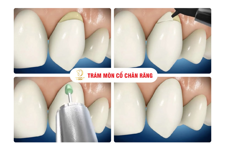 Trám cổ chân răng là cách để phục hình răng đơn giản và hiệu quả nhất