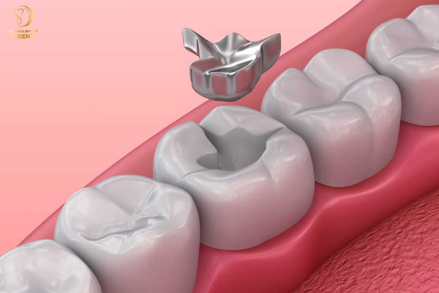 Hàn răng bằng Amalgam có khả năng phục hình hiệu quả, đặc biệt là những trường hợp răng sứt mẻ, gãy vỡ lớn