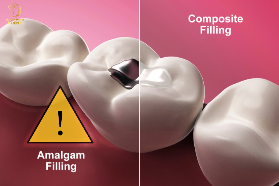 Trám răng bằng Amalgam