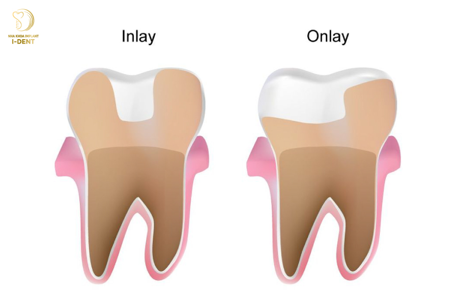 Trám răng Inlay Onlay là gì?