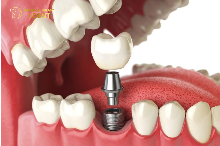 Phương pháp cấy ghép Implant