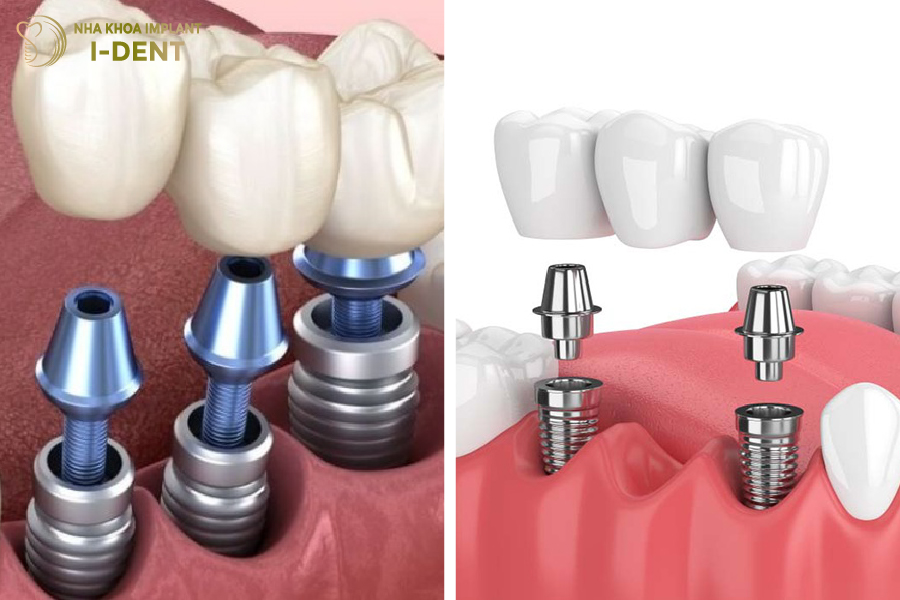 Trồng Implant cho 3 răng mất liên tiếp