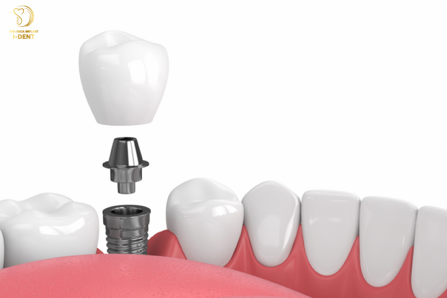 Răng Implant là loại răng giả tốt và hiện đại nhất hiện nay