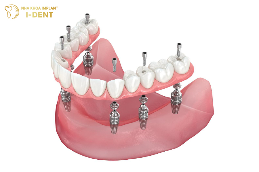 Trồng răng Implant toàn hàm All on 6